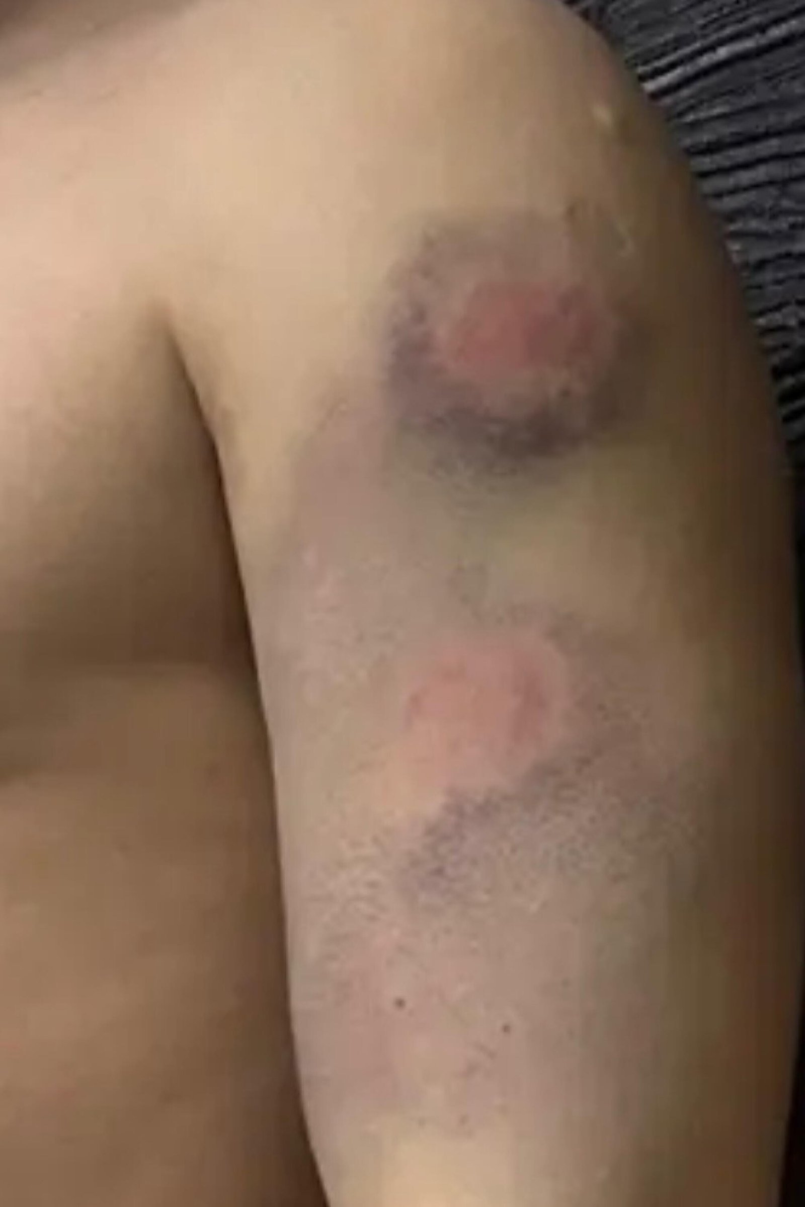 Un hematoma circular de color púrpura con una mancha roja en el centro de la parte superior del brazo del hombre. 